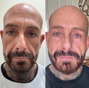 Before & After Neavia Stimulate Biostimulator