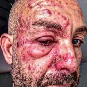 ???? Trigger Warning: The Profound Impact of Shingles on Skin Health ????