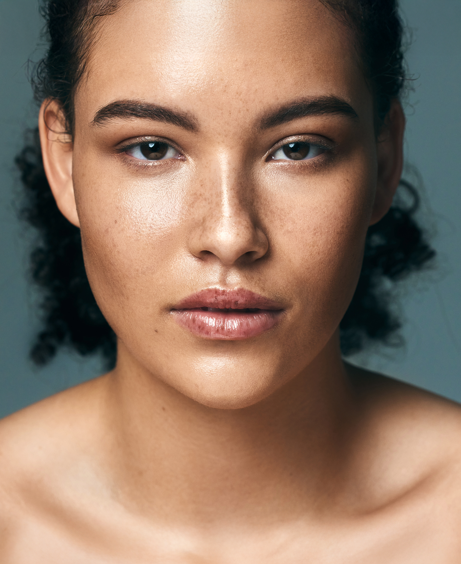 Skin pigmentation treatment results showing clearer, even-toned complexion at Nita McEvoy Clinic Enfield North London