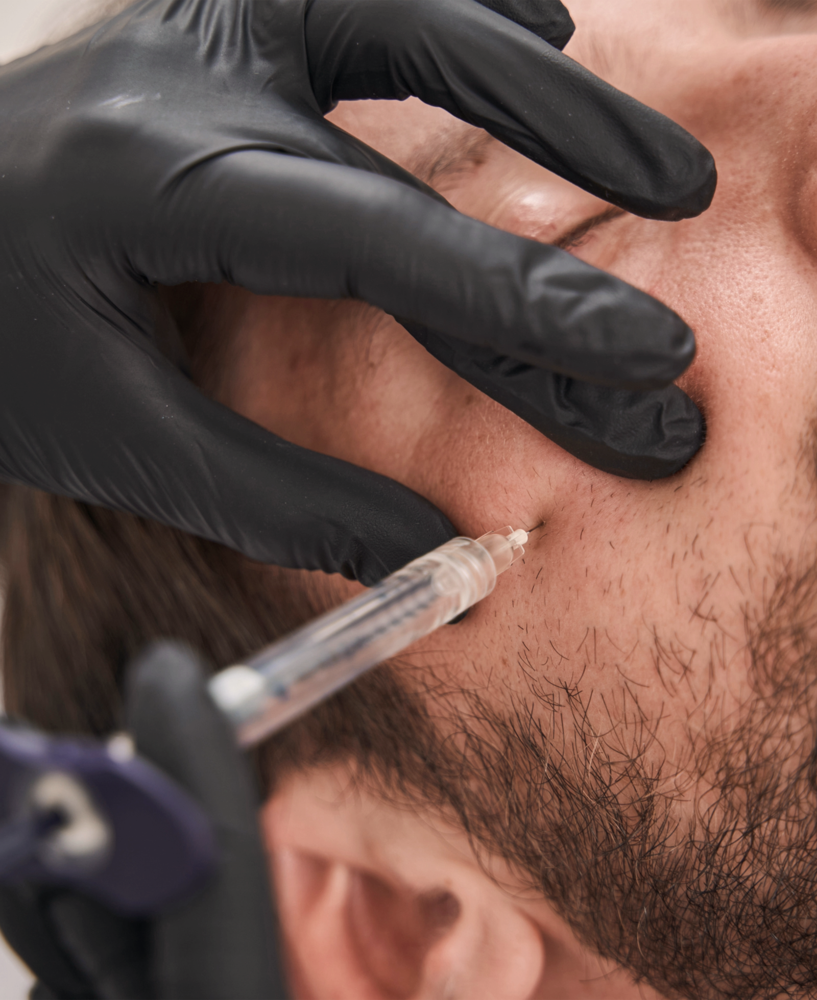 Male cheek filler treatment in Enfield North London by Nita McEvoy improving facial structure and definition