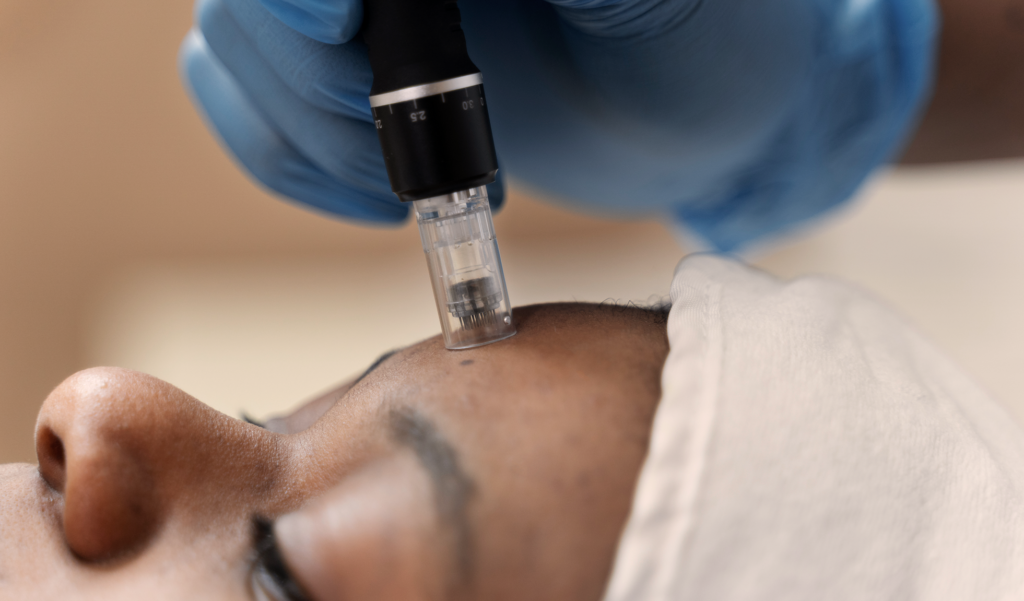 Microneedling treatment for regenerative skin rejuvenation in Enfield North London by Nita McEvoy