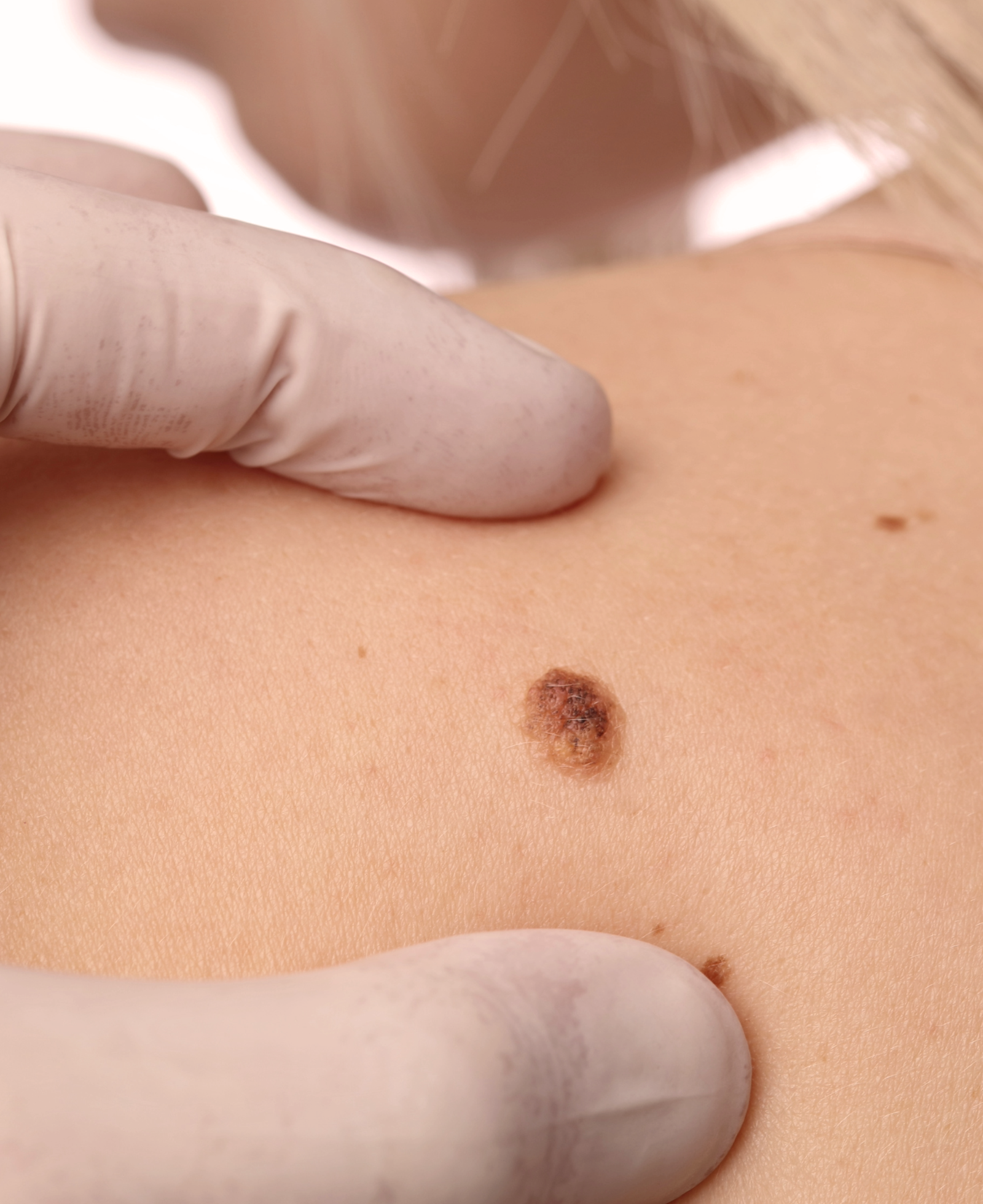 Mole and skin tag removal treatment in Enfield North London by Nita McEvoy using safe and precise techniques