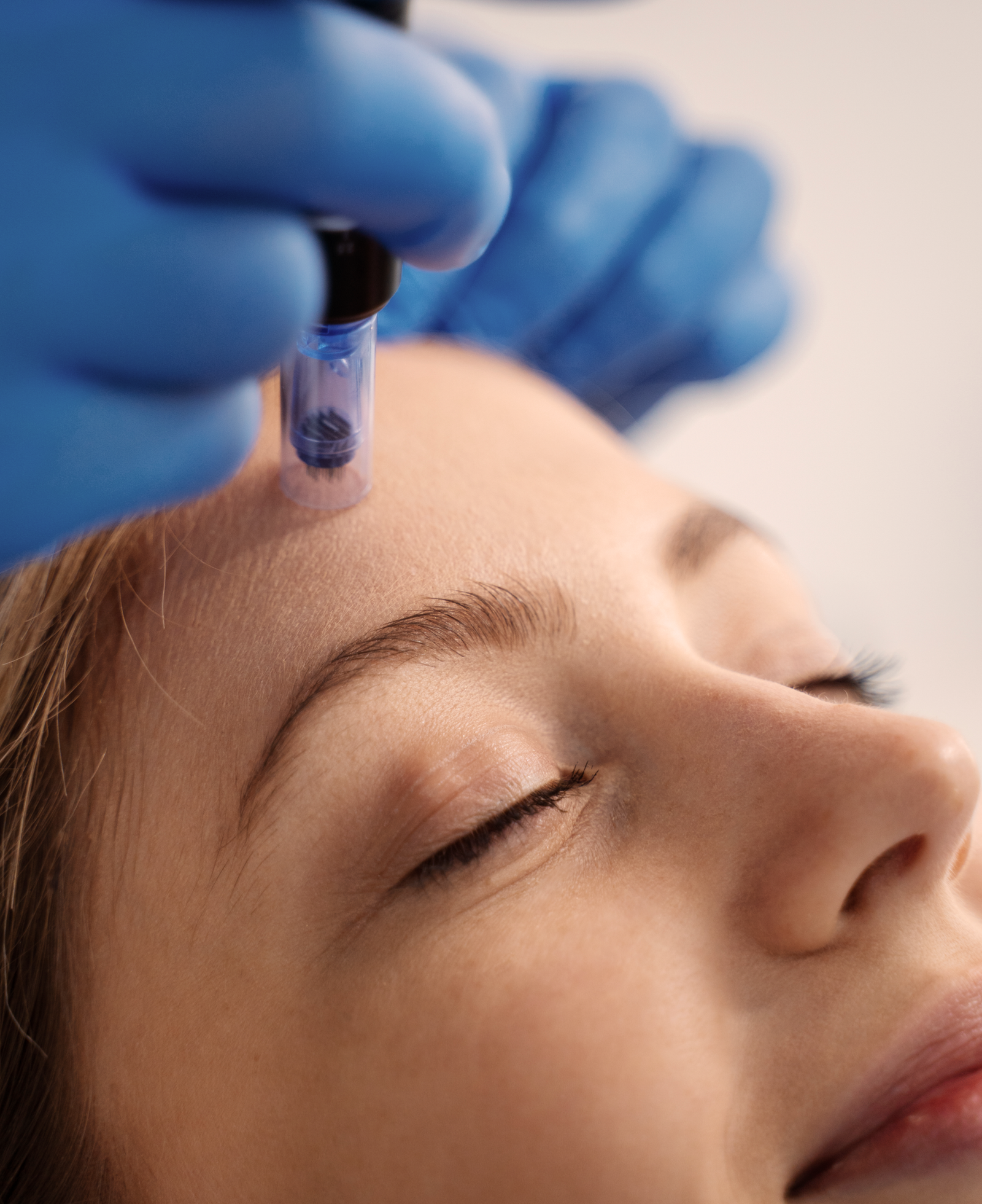Precision microneedling treatment on forehead in Enfield North London by Nita McEvoy for collagen stimulation and skin rejuvenation